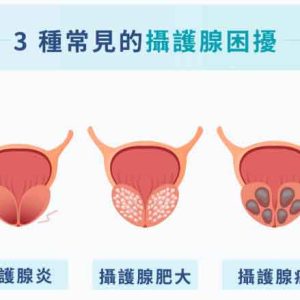 攝護腺發炎更要射精？醫師揭密「每週排毒次數」助腺體消腫 攝護腺炎多久一次性生活？